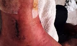 Arkeolojik kazı alanındaki çukura düşünce ayağında yüzde 3'lük engel oluştu; 1 milyon lira tazminat kararı çıktı