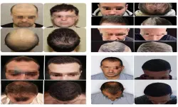 Възстановете самочувствието си с персонализирана трансплантация на коса