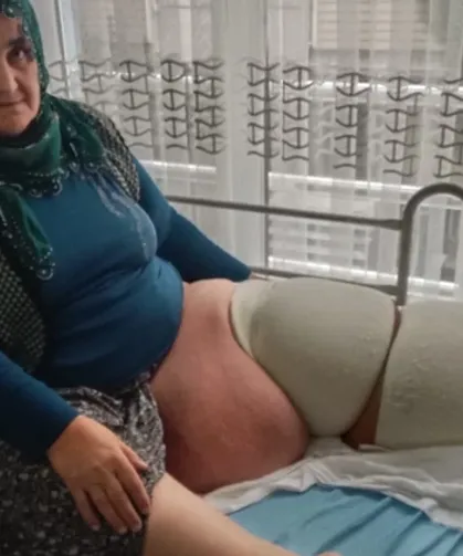 Mersin - 35 yıldır fil hastalığıyla mücadele ediyor