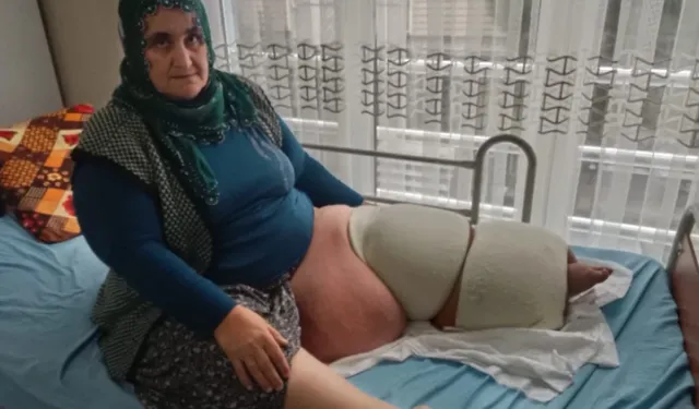 Mersin - 35 yıldır fil hastalığıyla mücadele ediyor