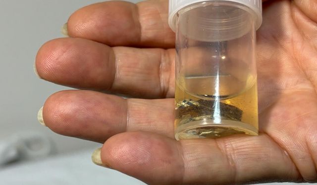 Alüminyum kabıyla yuttuğu hap, 4 yıl sonra akciğerinden çıkarıldı