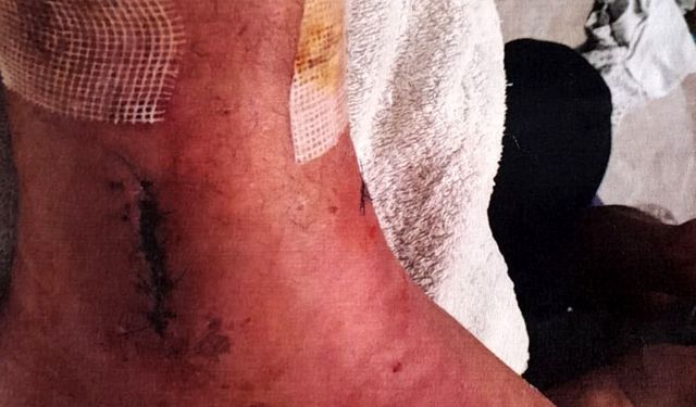 Arkeolojik kazı alanındaki çukura düşünce ayağında yüzde 3'lük engel oluştu; 1 milyon lira tazminat kararı çıktı