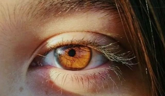 Yurt Dışından Gelen Hastalar İçin Laser Eye Color Change Turkey