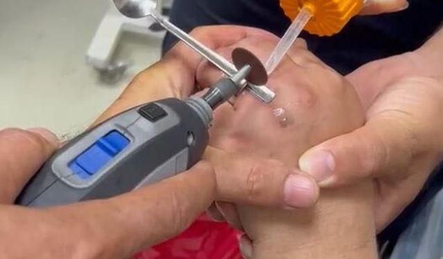 Parmağına sıkışan yüzüğü itfaiye çıkardı