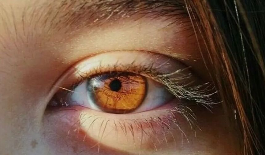 Yurt Dışından Gelen Hastalar İçin Laser Eye Color Change Turkey