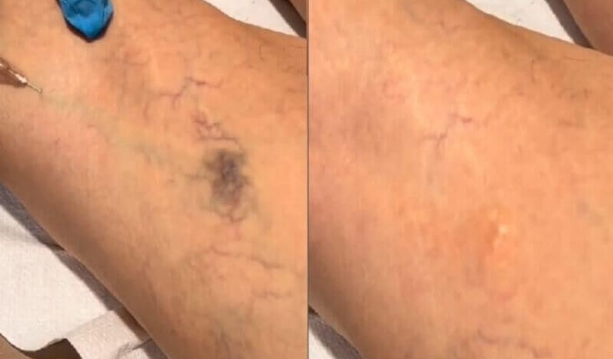 Bursa’da Yaşam Kalitenizi Yükseltecek Modern Varis Tedavisi Rehberi